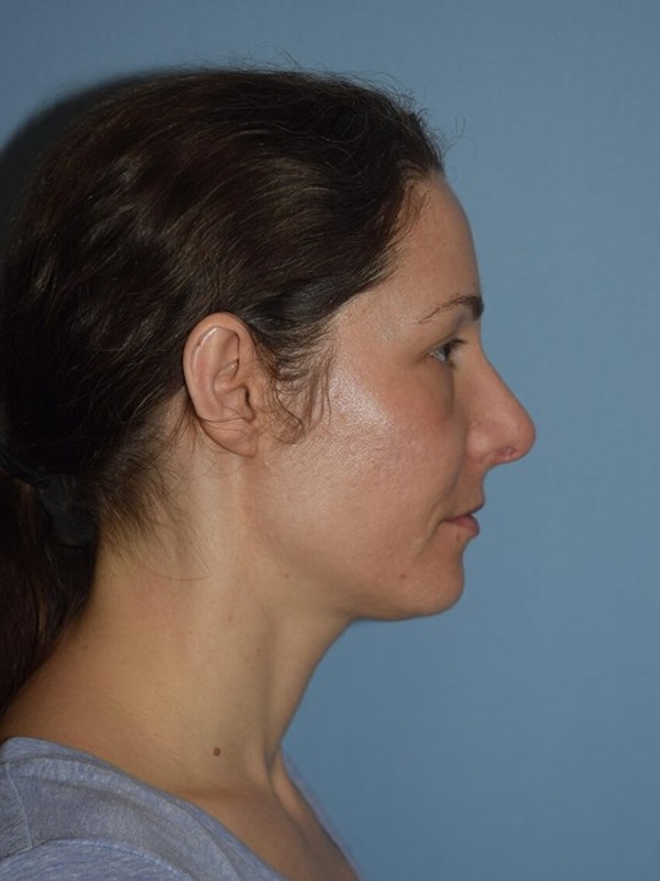 Rhinoplasty Before & After Gallery - Patient 14281861 - Image 2