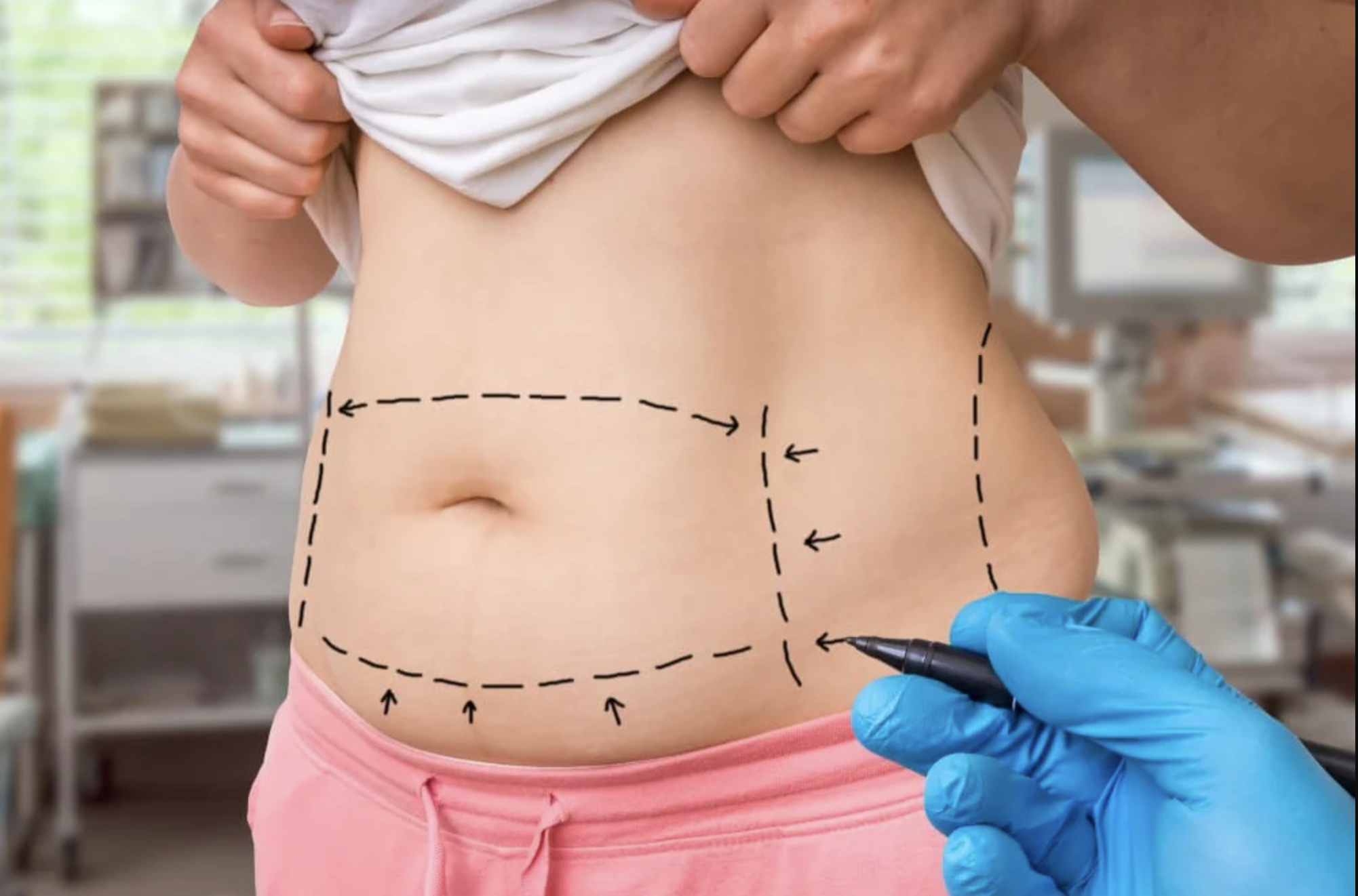 North Shore Cosmetic Surgery Blog | Your Guide to a Successful Tummy Lift Surgery and Recovery