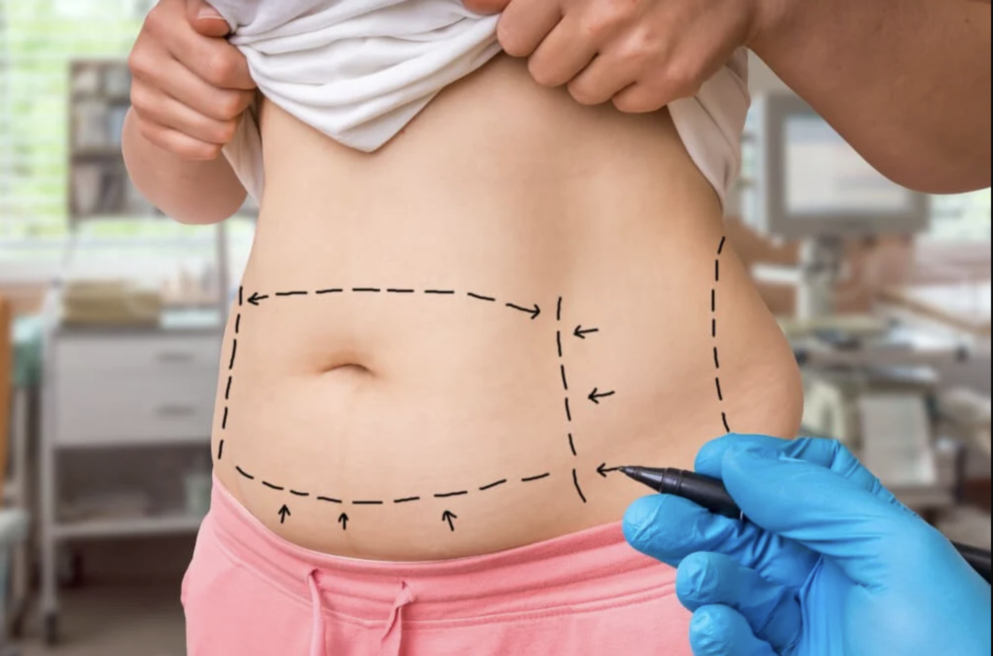 Your Guide to a Successful Tummy Lift Surgery and Recovery, Blog