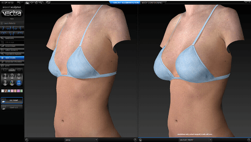 3D imaging of breast enhancement before and after