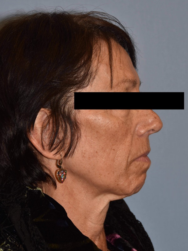 Facelift Before & After Gallery - Patient 14281774 - Image 4