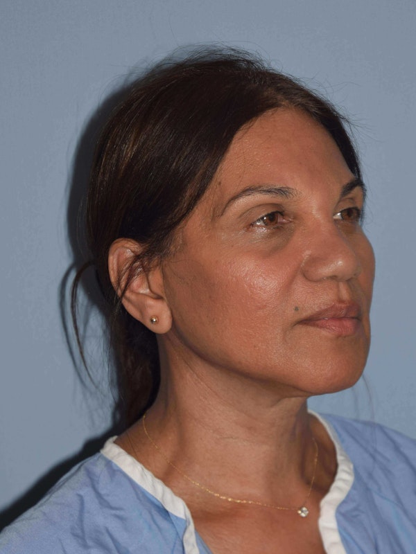Facelift Before & After Gallery - Patient 9563928 - Image 4