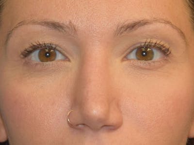 Eyelid Lift Before & After Gallery - Patient 9567805 - Image 1