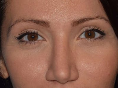 Eyelid Lift Before & After Gallery - Patient 9567805 - Image 2