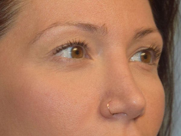 Eyelid Lift Before & After Gallery - Patient 9567805 - Image 3