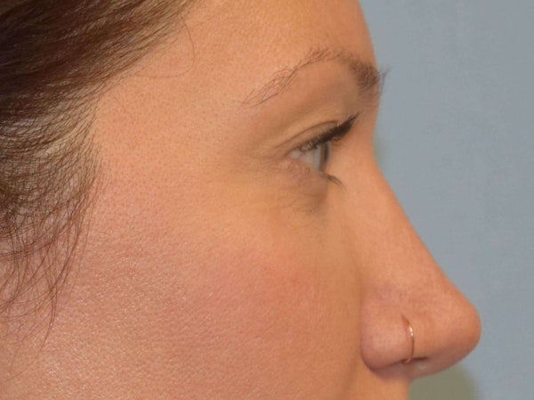 Eyelid Lift Before & After Gallery - Patient 9567805 - Image 5