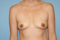 Breast Augmentation  Before & After Gallery - Patient 9567905 - Image 1