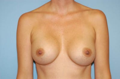 Breast Augmentation  Gallery - Patient 9567905 - Image 2