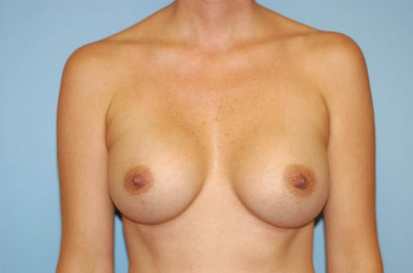 Breast Augmentation  Before & After Gallery - Patient 9567905 - Image 2