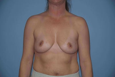 Breast Augmentation Before & After Gallery - Patient 14281514 - Image 1