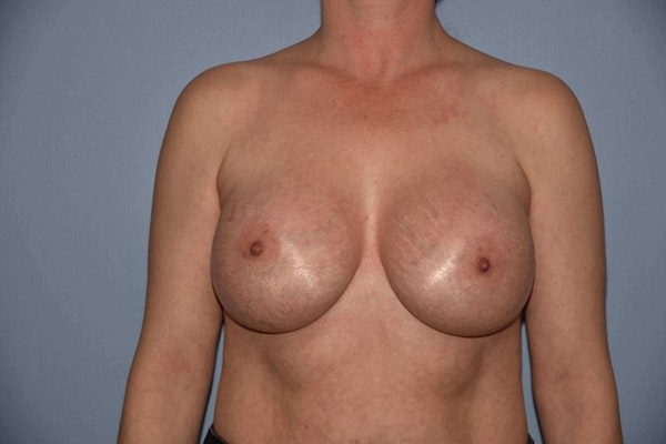 Breast Augmentation Before & After Gallery - Patient 14281514 - Image 2
