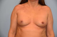 Breast Augmentation Gallery - Patient 14281515 - Image 1
