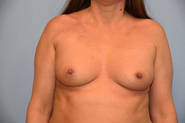 Breast Augmentation Before & After Gallery - Patient 14281515 - Image 1