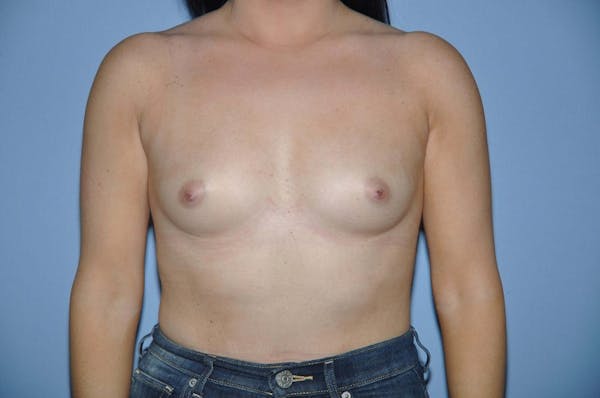 Breast Augmentation  Gallery - Patient 9567914 - Image 1