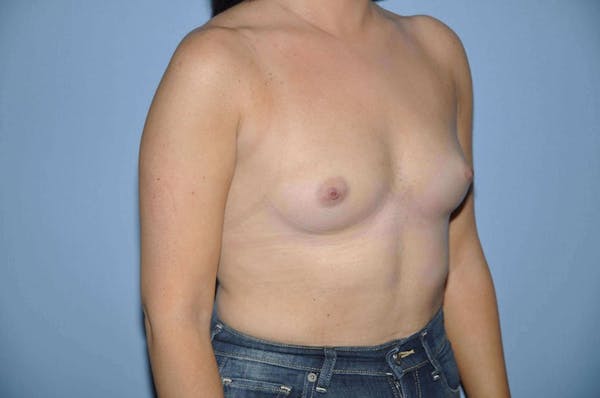 Breast Augmentation  Gallery - Patient 9567914 - Image 3