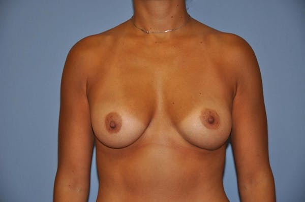 Breast Augmentation  Before & After Gallery - Patient 9567930 - Image 2