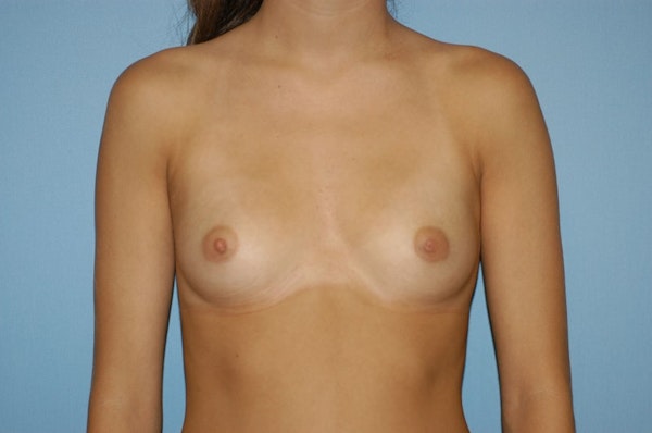Breast Augmentation  Before & After Gallery - Patient 9567955 - Image 1