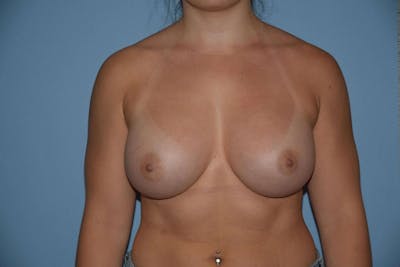 Breast Augmentation  Before & After Gallery - Patient 9567972 - Image 2