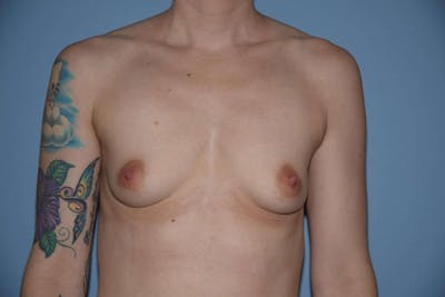 Breast Augmentation  Gallery - Patient 9567990 - Image 1