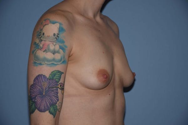 Breast Augmentation  Before & After Gallery - Patient 9567990 - Image 3