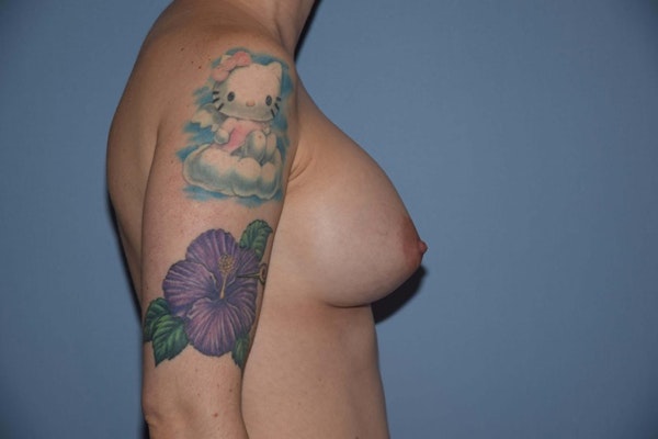 Breast Augmentation  Before & After Gallery - Patient 9567990 - Image 6