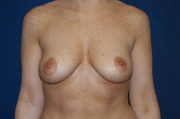 Breast Augmentation  Before & After Gallery - Patient 9567994 - Image 1
