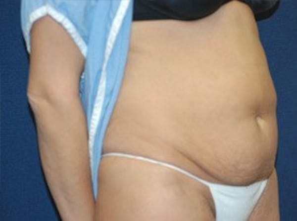 Tummy Tuck Before & After Gallery - Patient 9568111 - Image 3