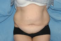 Tummy Tuck Before & After Gallery - Patient 9568114 - Image 1