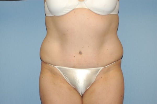 Tummy Tuck Before & After Gallery - Patient 9568114 - Image 2