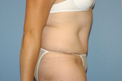 Tummy Tuck Before & After Gallery - Patient 9568114 - Image 6