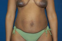 Tummy Tuck Before & After Gallery - Patient 9568117 - Image 1