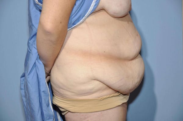 Tummy Tuck Before & After Gallery - Patient 9568122 - Image 5