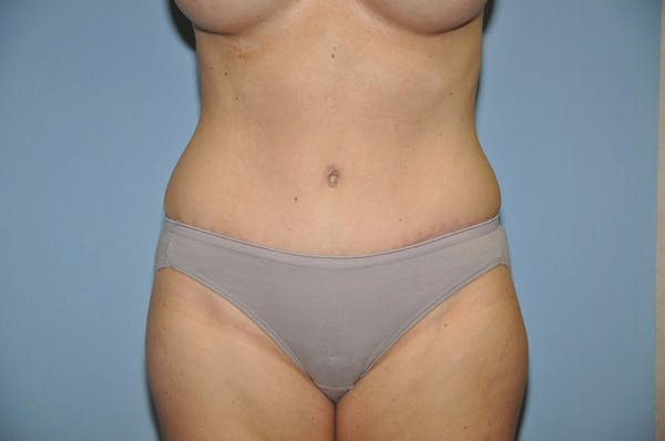 Tummy Tuck Gallery - Patient 9568124 - Image 2
