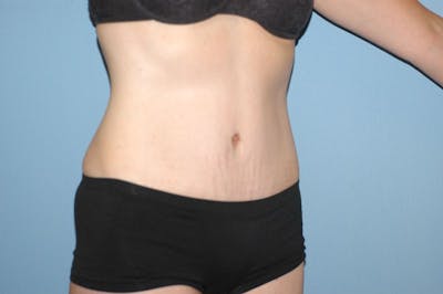 Tummy Tuck Before & After Gallery - Patient 9568141 - Image 4