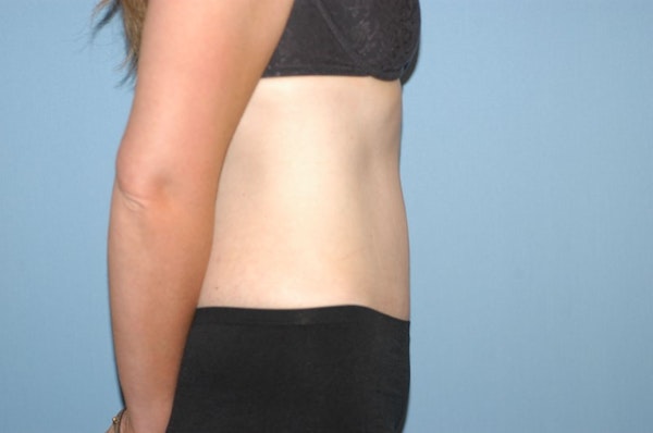 Tummy Tuck Before & After Gallery - Patient 9568141 - Image 6
