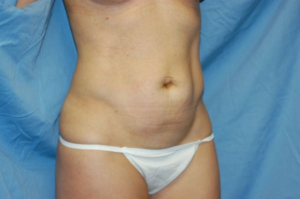 Tummy Tuck Gallery - Patient 9568142 - Image 3