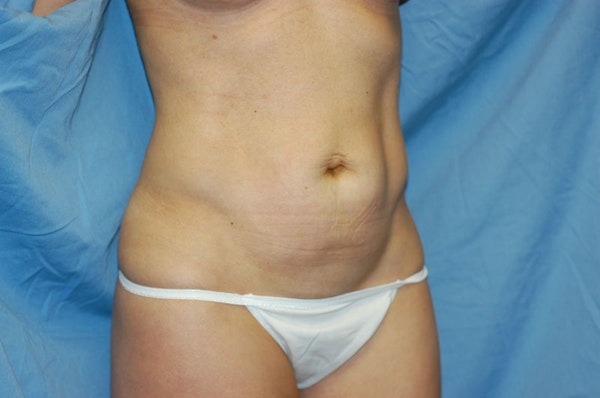 Tummy Tuck Before & After Gallery - Patient 9568142 - Image 3
