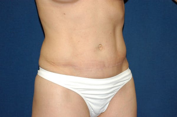Tummy Tuck Gallery - Patient 9568142 - Image 4