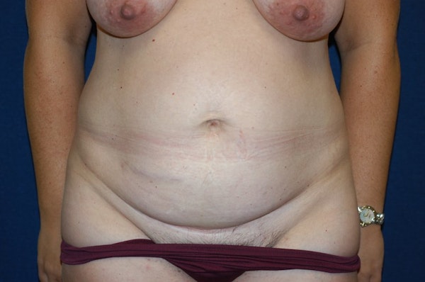 Tummy Tuck Before & After Gallery - Patient 9568146 - Image 1