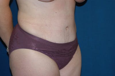 Tummy Tuck Before & After Gallery - Patient 9568146 - Image 4