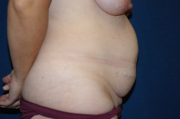 Tummy Tuck Gallery - Patient 9568146 - Image 5