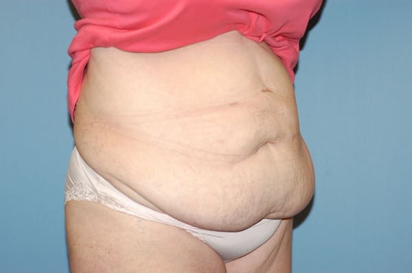 Tummy Tuck Gallery - Patient 9568148 - Image 3