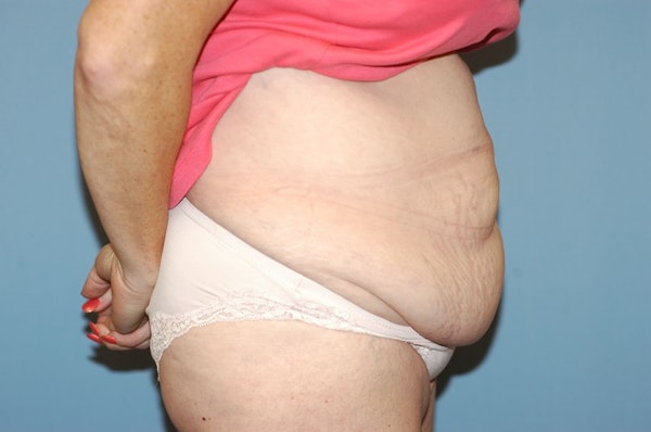 Tummy Tuck Before & After Gallery - Patient 9568148 - Image 5