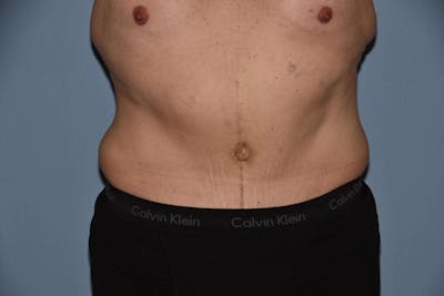 Tummy Tuck Before & After Gallery - Patient 9568153 - Image 2