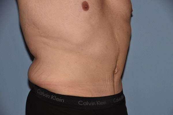 Tummy Tuck Before & After Gallery - Patient 9568153 - Image 4