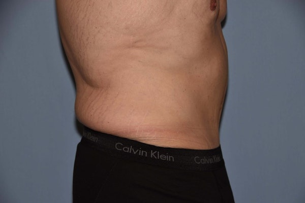 Tummy Tuck Before & After Gallery - Patient 9568153 - Image 6