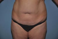 Tummy Tuck Before & After Gallery - Patient 9568162 - Image 1
