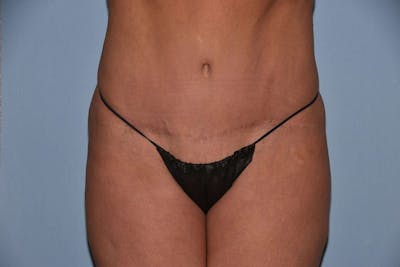 Tummy Tuck Before & After Gallery - Patient 9568162 - Image 2