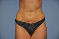 Tummy Tuck Before & After Gallery - Patient 9568167 - Image 1