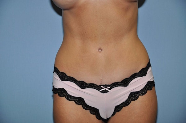 Tummy Tuck Before & After Gallery - Patient 9568167 - Image 2